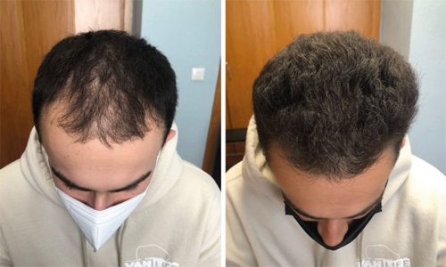 Dr Jorge Hernández - Tricología & Implante capilar