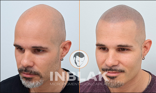 INBLAK Micropigmentación Capilar