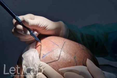 Clinica Capilar Leticap