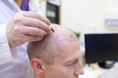 Clínica capilar Medican Clinics